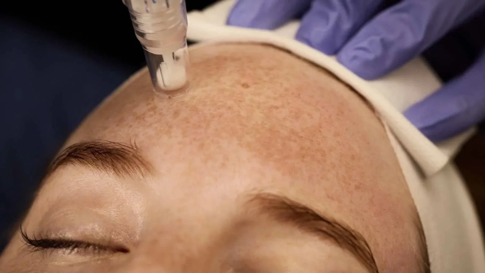 A person receiving a cosmetic injection on their forehead, with a healthcare professional wearing blue gloves administering the treatment.