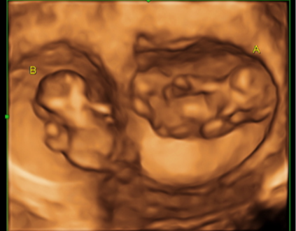 High-resolution 3D ultrasound image of twins at 12 weeks, capturing two unborn babies resting side by side inside the womb.