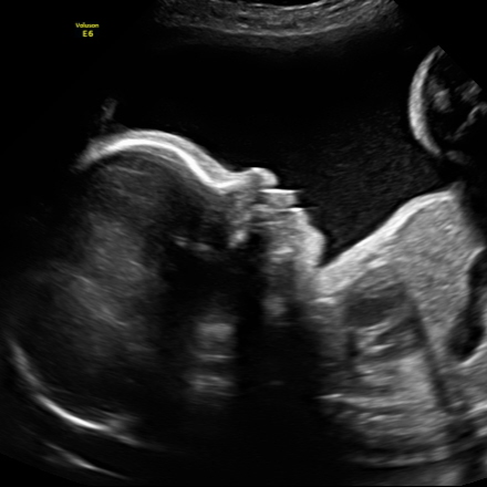 2D ultrasound image showing a baby's profile.