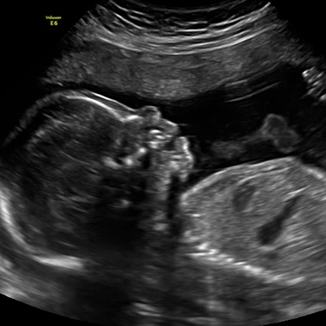 2D ultrasound image of a baby in the second trimester.