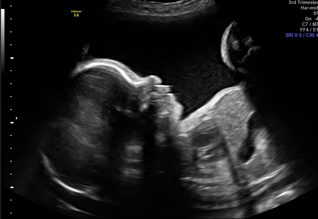 2D ultrasound image showing a baby's profile.
