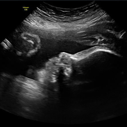 2D ultrasound image of a baby in the third trimester.