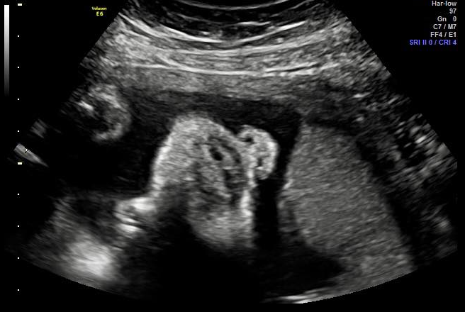 Black-and-white prenatal ultrasound image showing a close-up view of an unborn baby’s nose and lips.