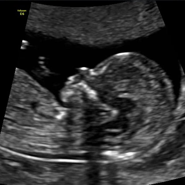 2D ultrasound image of a developing baby in the womb.
