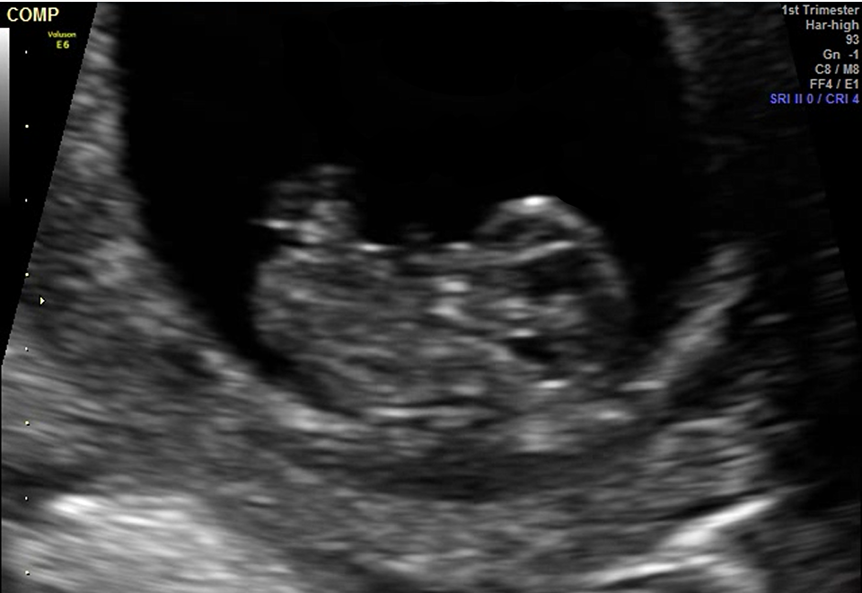 2D ultrasound image of a developing baby in the first trimester.