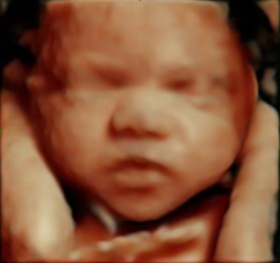 High-resolution 3D ultrasound image showing an unborn baby’s face with eyes closed and arms resting on each side of the face.