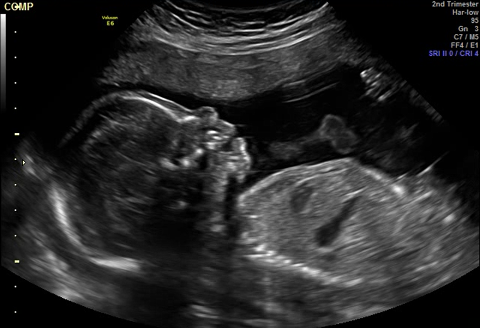 2D ultrasound image of a baby in the second trimester.