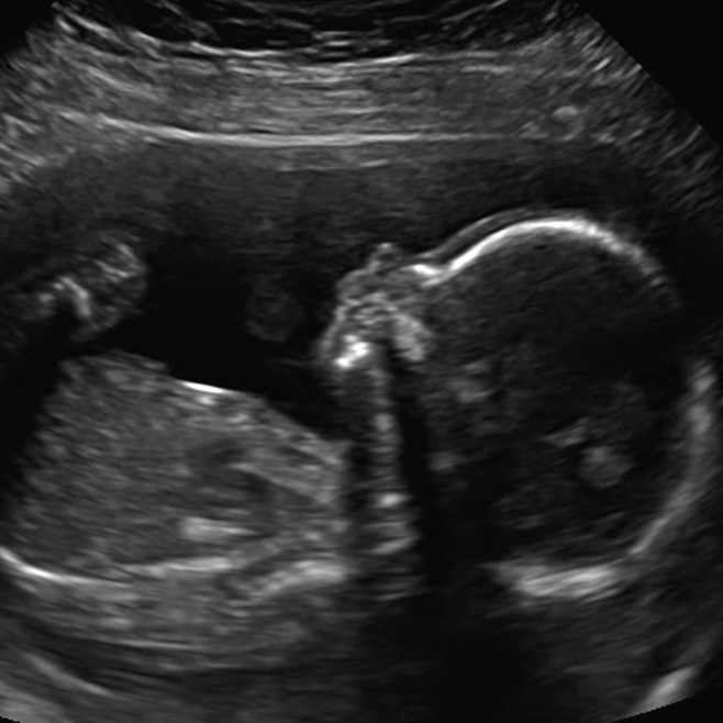 2D ultrasound image of a baby in the second trimester.