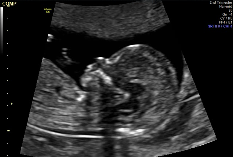 2D ultrasound image of a developing baby in the womb.