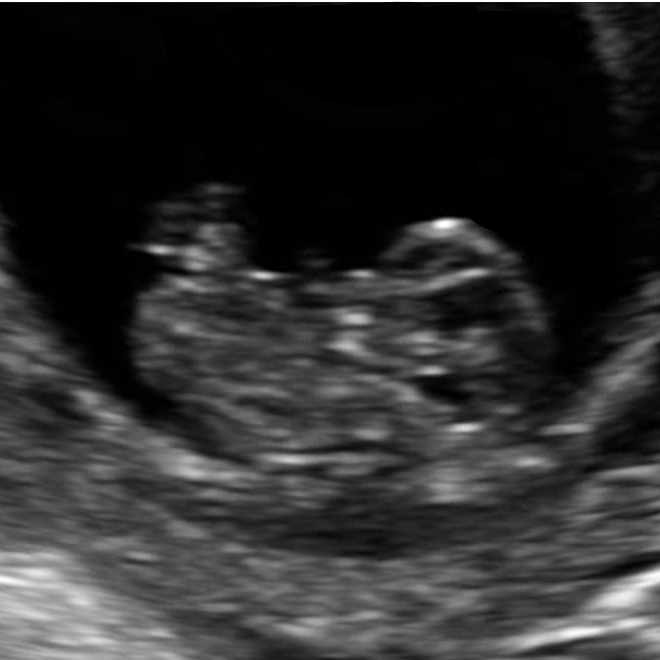 2D ultrasound image of a developing baby in the first trimester.