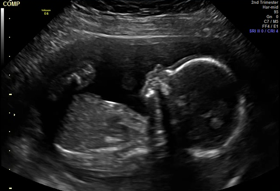 2D ultrasound image of a baby in the second trimester.