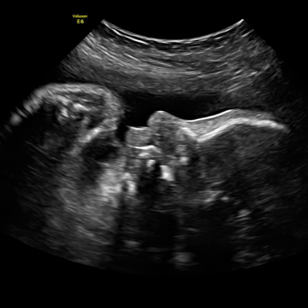 2D ultrasound image showing a baby's profile.