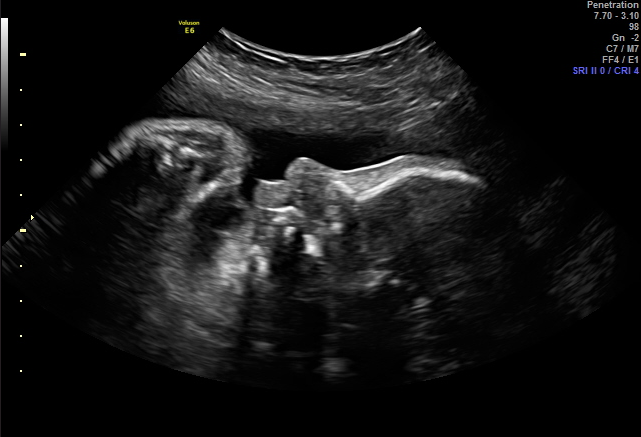2D ultrasound image showing a baby's profile.