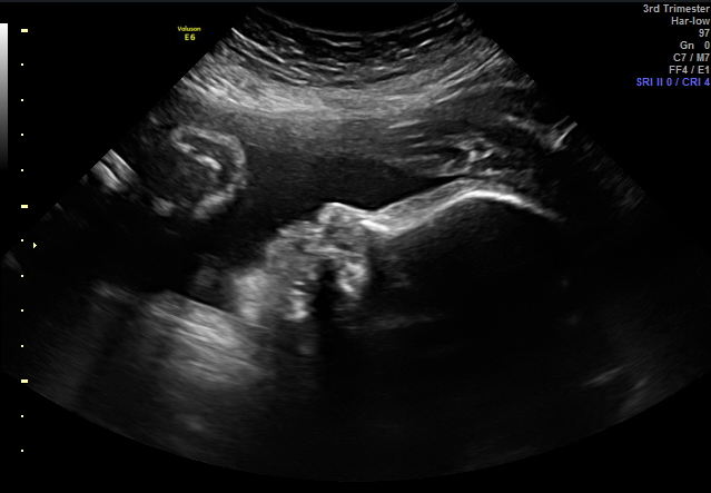 2D ultrasound image of a baby in the third trimester.