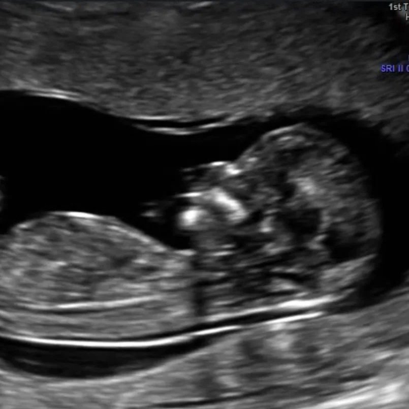 Black-and-white prenatal ultrasound image showing a side profile view of a 13-week unborn baby inside the womb.