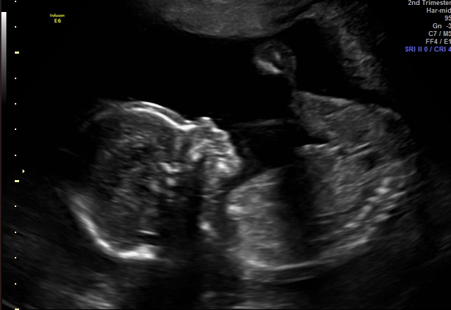 Black-and-white prenatal ultrasound image showing a side profile view of an unborn baby inside the womb.