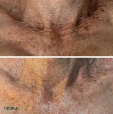 Before and after comparison of skin treatment on a neck