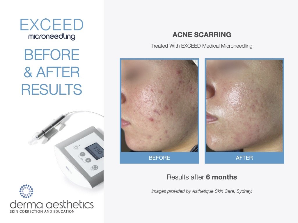 Microneedling before and after results for acne scarring, showing skin improvements over 6 months with EXCEED Medical Microneedling system.