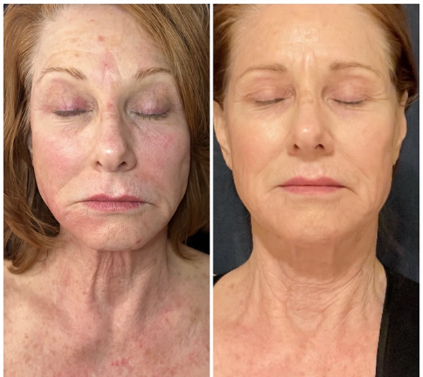 Side-by-side comparison of a woman's face before and after a cosmetic treatment, showing reduced redness and improved skin texture.