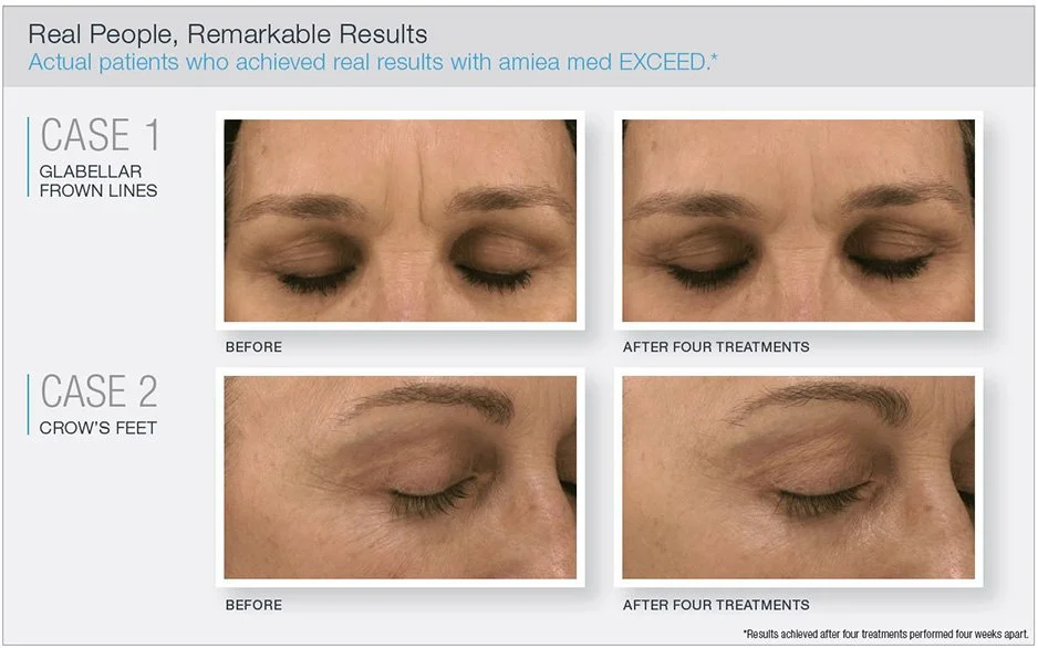 Before and after images showing the effects of amiea med EXCEED treatments on glabellar frown lines and crow's feet, labeled Case 1 and Case 2 respectively, with noticeable improvements after four treatments.