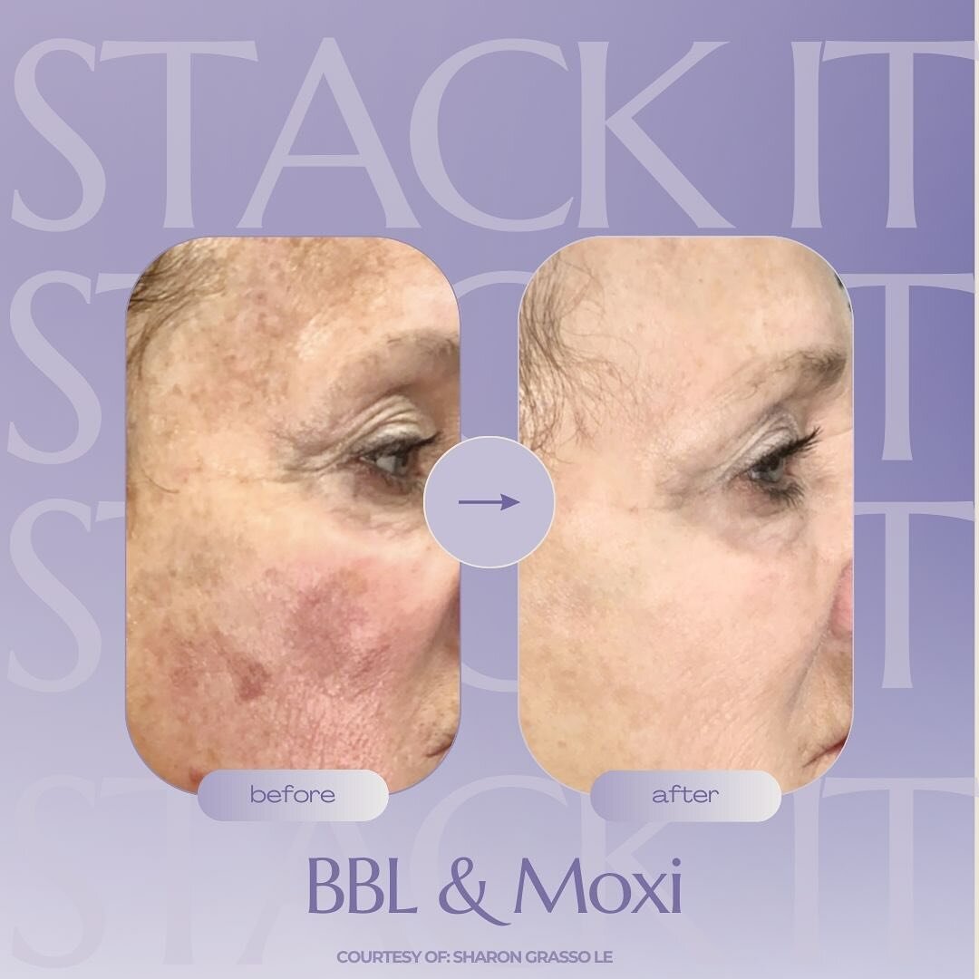 MOXI &amp; BroadBand Light (BBL ) &mdash;two advanced skin treatments that pair perfectly for dramatic results with little to no downtime. 

Moxi delivers fractionated laser energy to create micro-coagulation zones which the body then repairs, replac