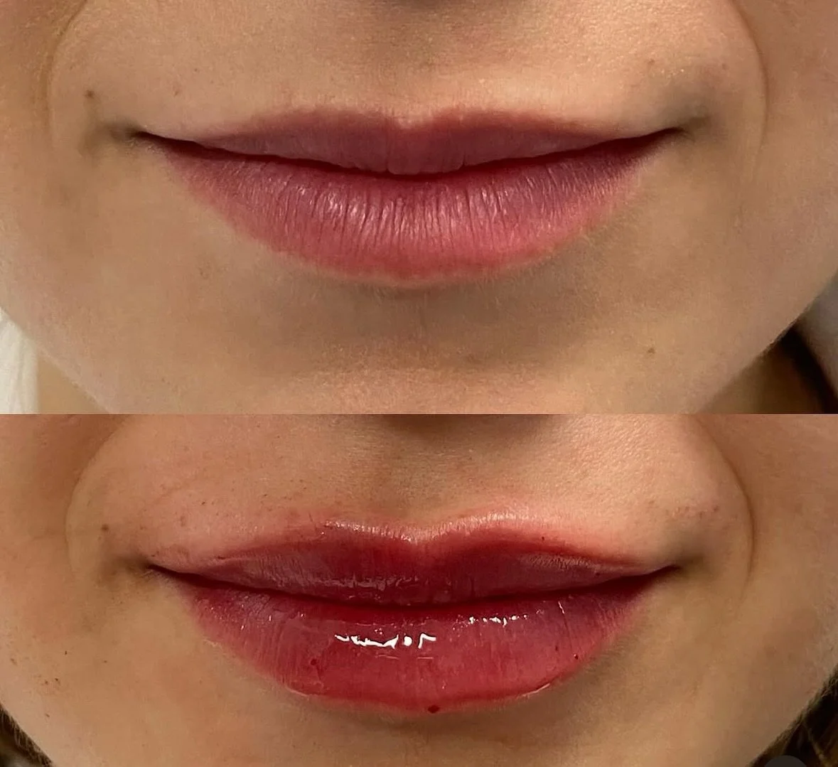 Natural looking lips with the perfect amount of filler 👏🏼
Our goal is to make you the most beautiful natural version of you, confident in your own skin.
#lipfiller #filler #naturallook #skingoals #skincareproducts #tulsa #oklahoma #tulsaok #tulsa