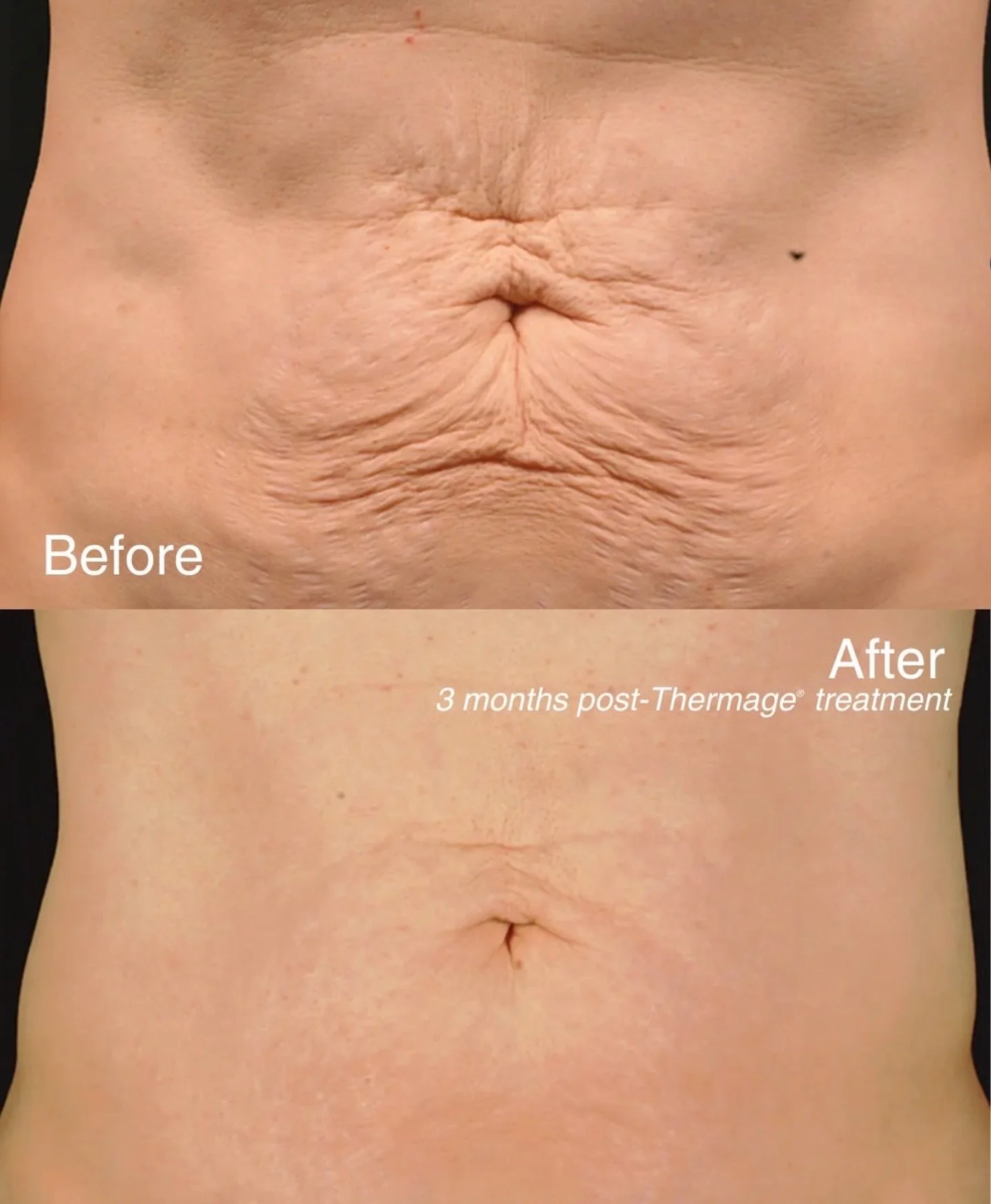 #thermage 
Non-invasive skin tightening treatment that uses radiofrequency energy to heat the deep layers of the skin, stimulating collagen production and resulting in a smoother, tighter, and more youthful appearance.
Our patients are loving their