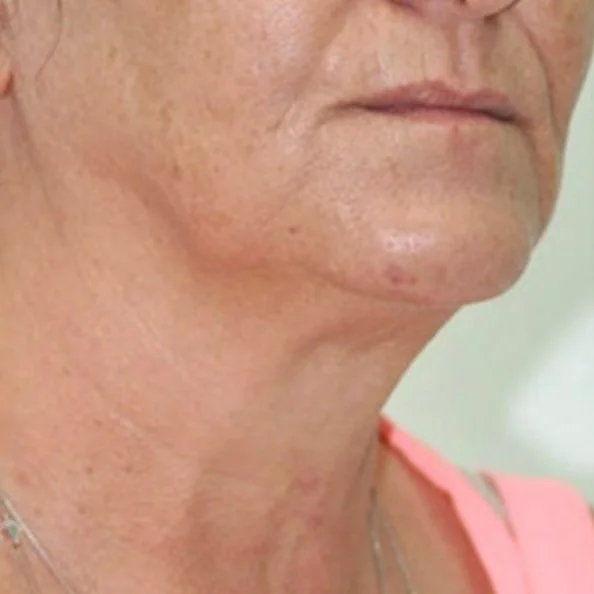 After skin rejuvenation (1).jpg