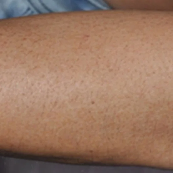 after forearm laser hair removal.jpg