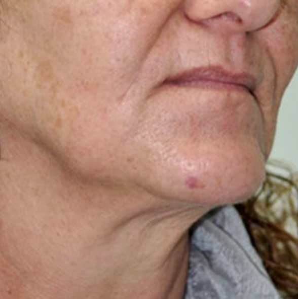 Before skin Rejuvenation (1).png