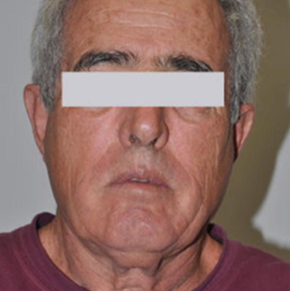 Before Skin Rejuvenation (3).png