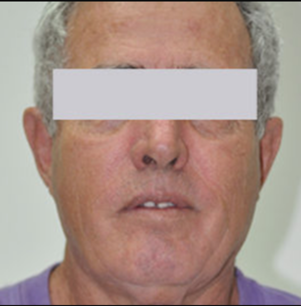 After Skin Rejuvenation (3).png