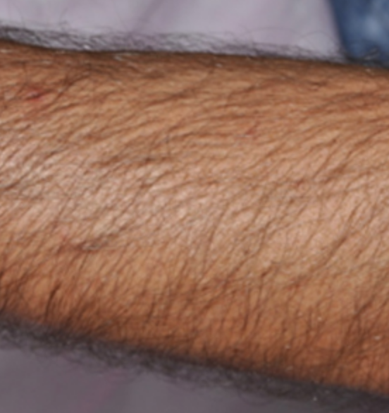 before forearm laser hair removal.png