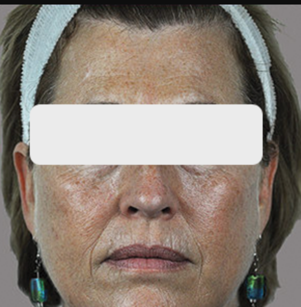 Before Skin Rejuvenation (4).png