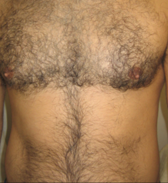 Before Laser On Chest.png