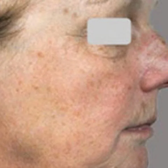 Before Skin Rejuvenation (2).jpg