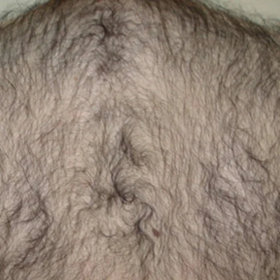 Before Back Laser Hair removal.jpg