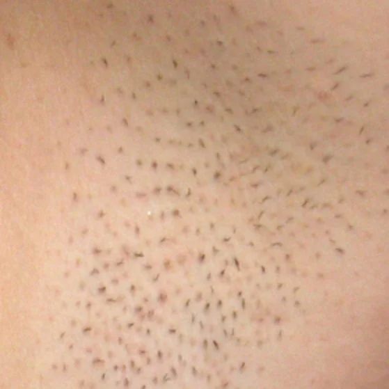 Before Laser Treatment (armpits).jpg