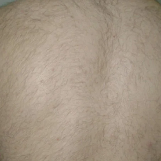 After Back Laser hair removal.jpg