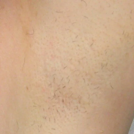 After Laser Treatment (Armpits).jpg