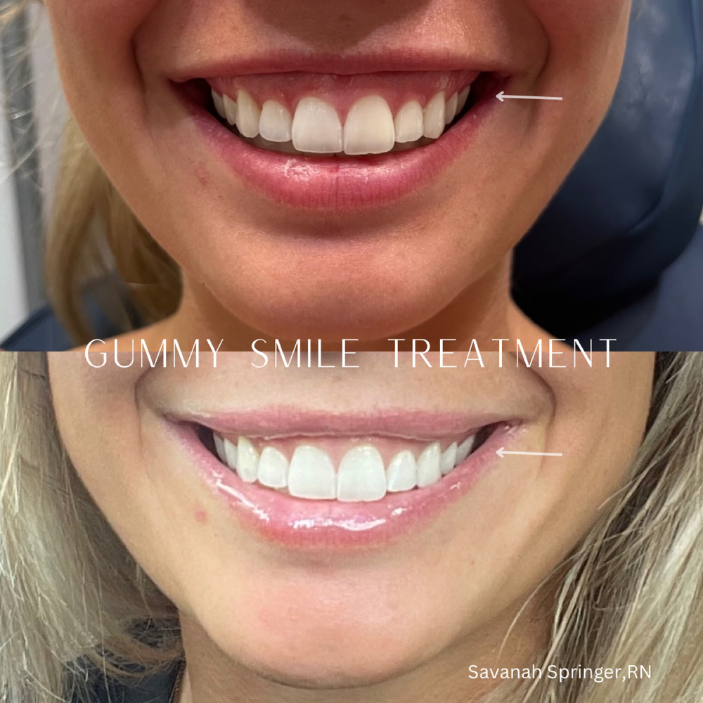 Comparison of a person's smile before and after gummy smile treatment, showing improved gum coverage and brighter teeth.