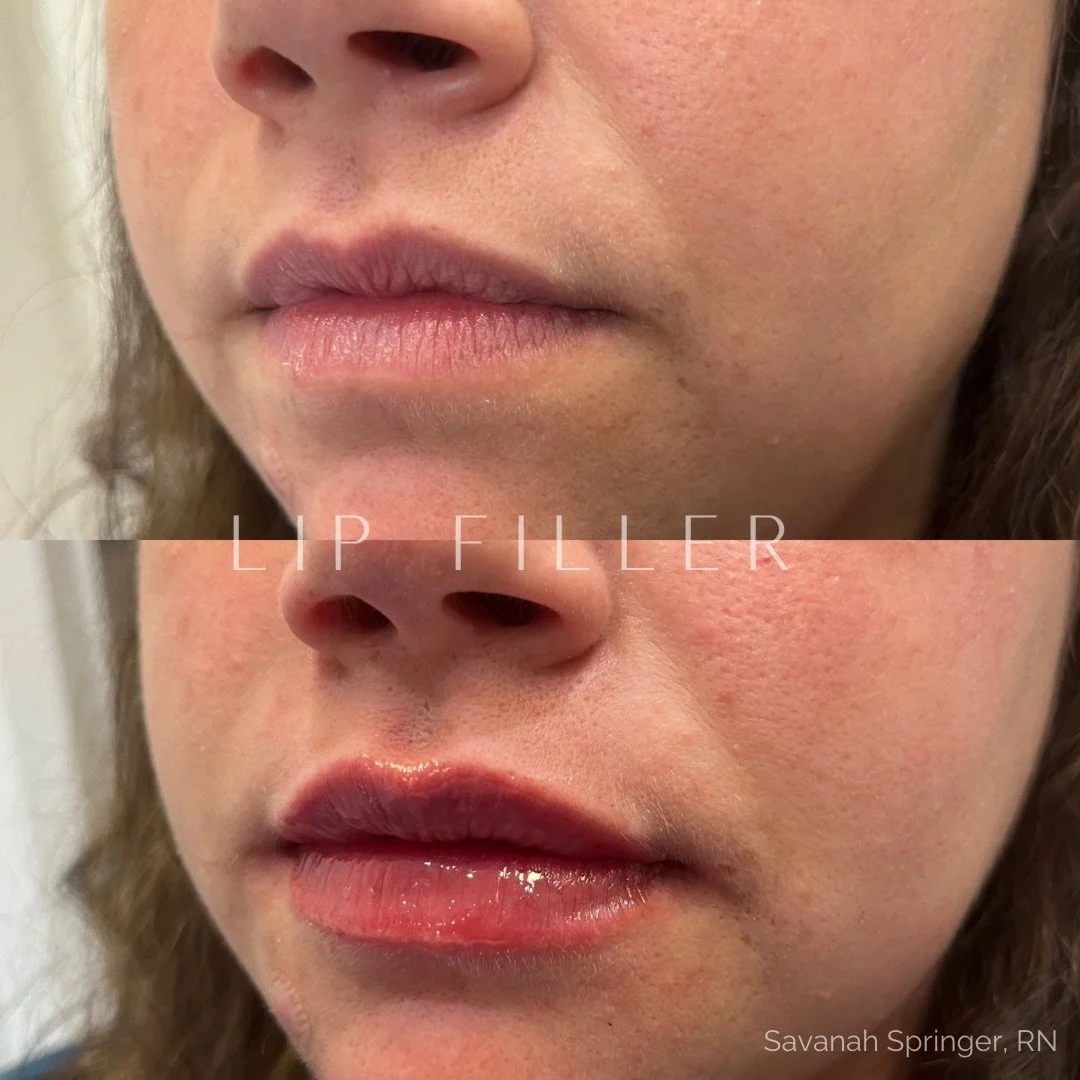 Before and after photos of lip filler treatment showing fuller, shiny lips in the after image.