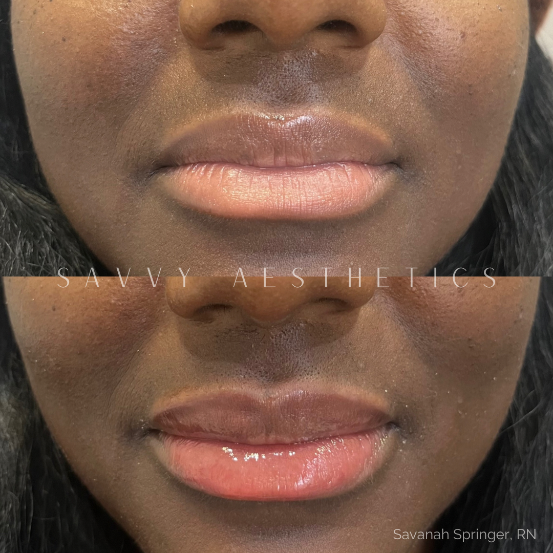 Close-up of a woman's lips before and after lip gloss application, showing smoother, shinier lips in the after photo.