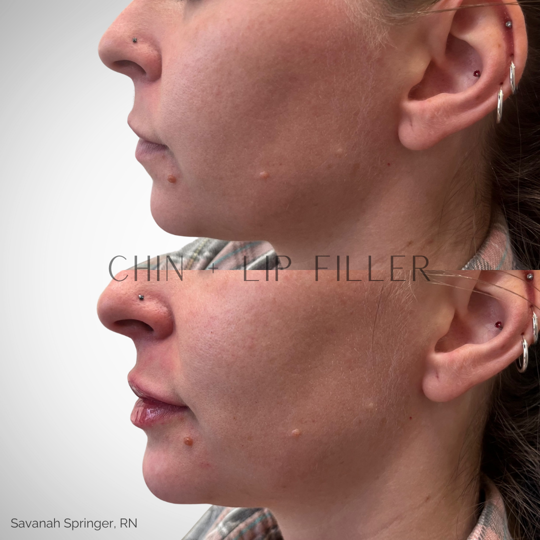 Before and after images of a woman's face showing chin and lip filler treatment. The upper image shows her chin and lips before the procedure, and the lower image shows her after the procedure with enhanced chin and fuller lips.