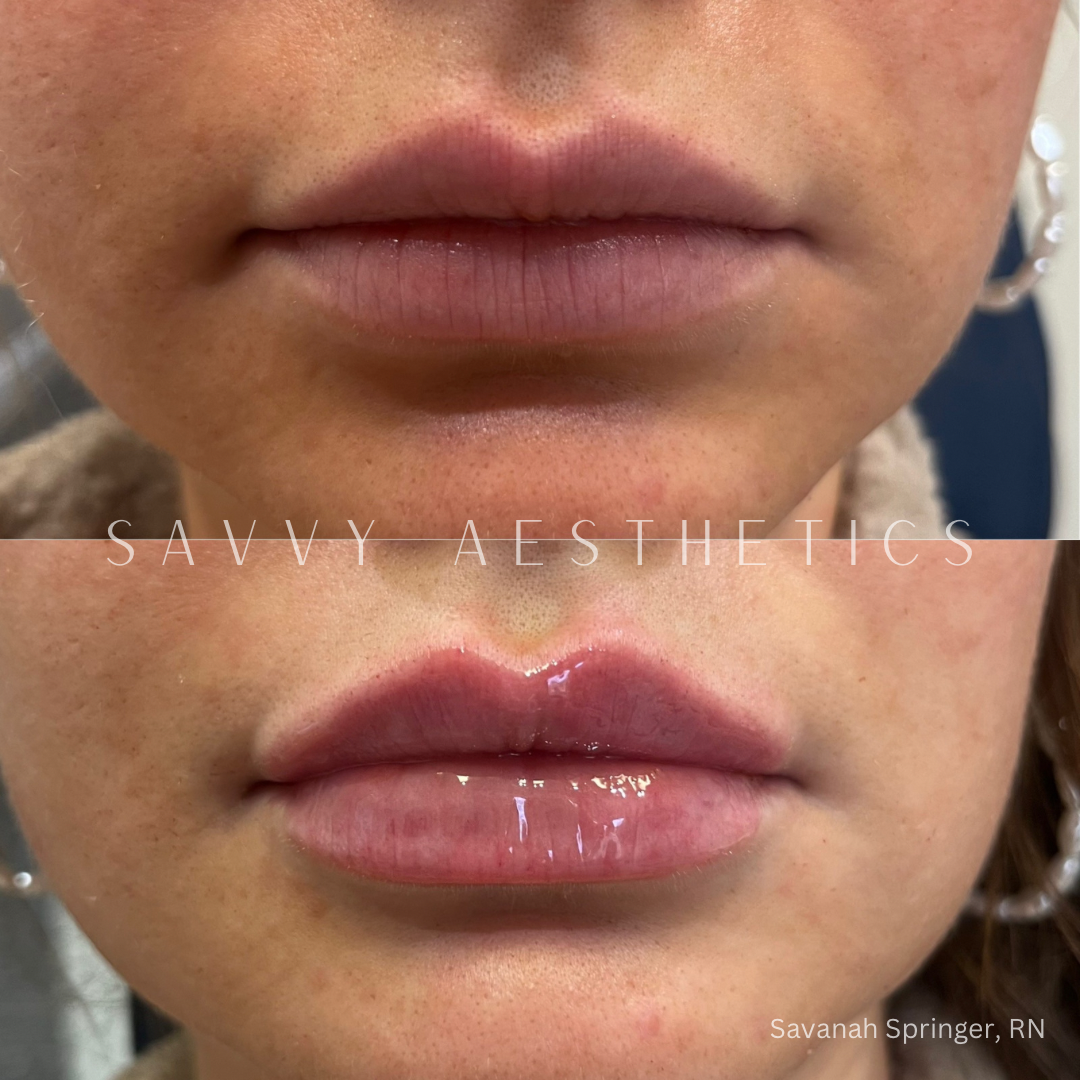 A before-and-after comparison of lips, showing lip enhancement with more fullness and gloss in the after image.