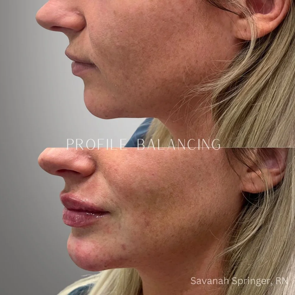 Side-by-side comparison of a woman's face showing the before and after results of profile balancing treatment, highlighting improvements in skin texture, cheek contour, and lip fullness.