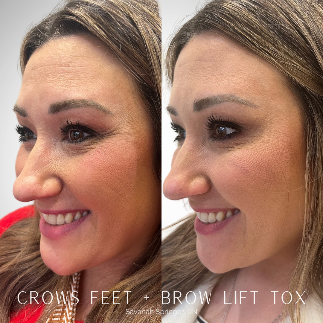 Side-by-side comparison of a woman's face showing the effects of Crows Feet and Brow Lift Tox treatments, with smoother skin on the right.