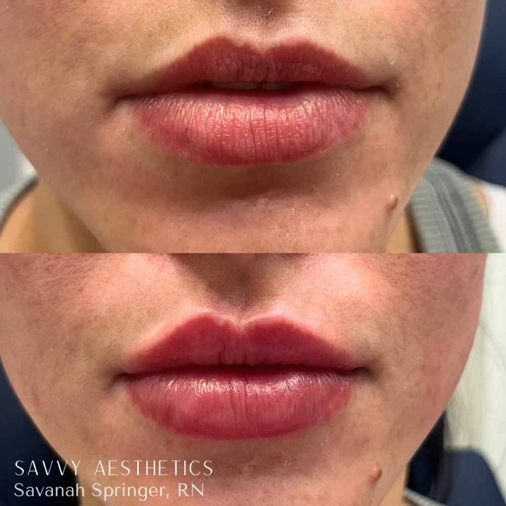 Comparison of lips before and after cosmetic enhancement, showing fuller, more defined lips post-procedure.