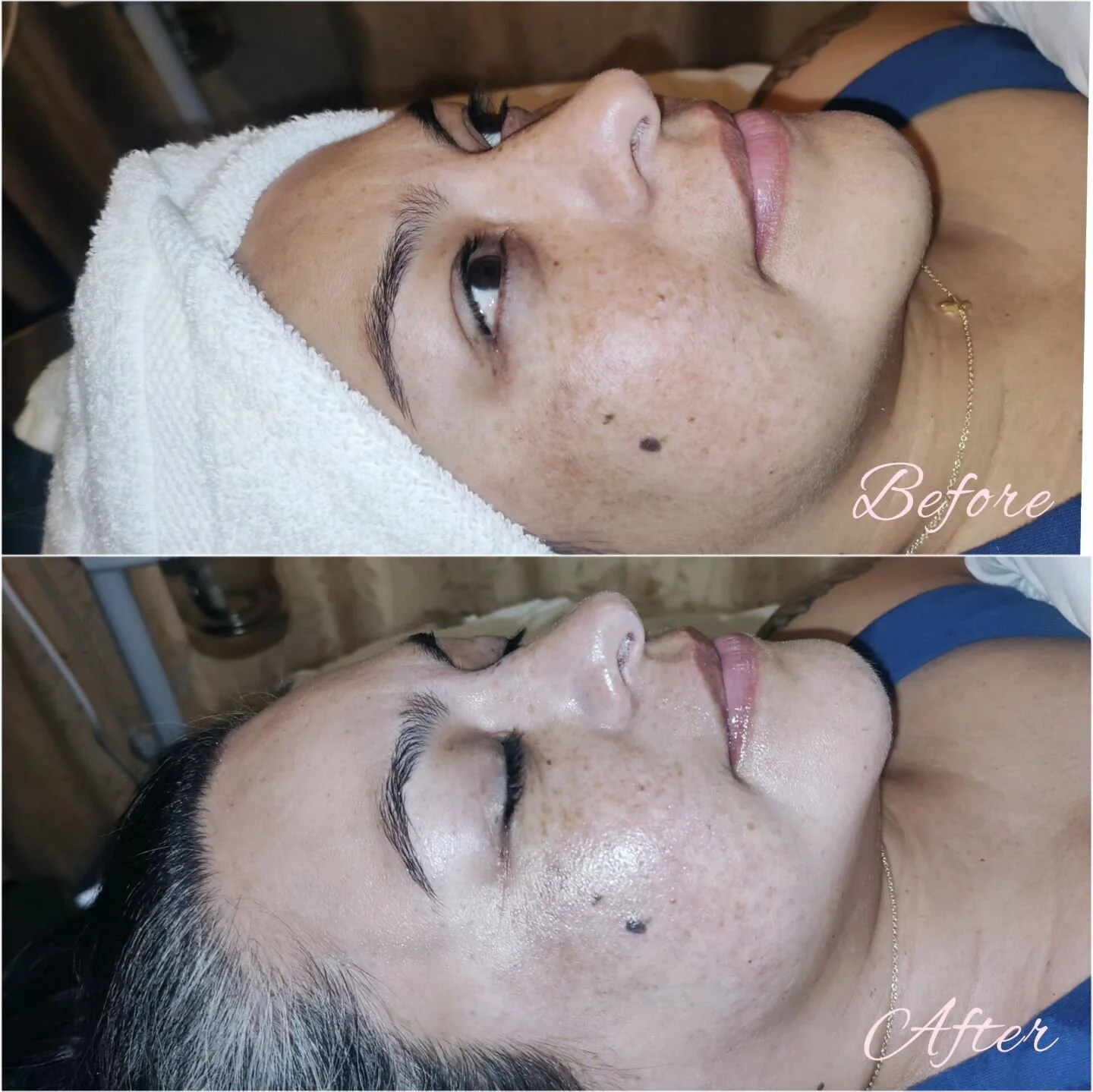 DERMAPLANING..

What is it? 

Shaving your face? Isn't that for men (or maybe women) with beards and moustaches? 

No, my friends. 

A dermaplane facial is one of the best exfoliating treatments for your skin. And the GLOW afterwards 🌟

Using a surg