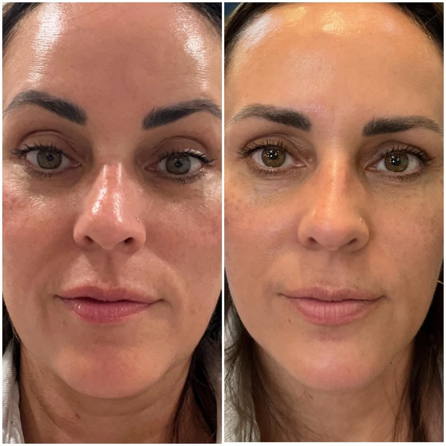 ✨ It&rsquo;s not about how much filler you use, but where you place it ✨

Just a little piriform filler can make such a difference in softening the nasolabial folds. The result? A fresher, more balanced look &mdash; without looking overdone.

This be